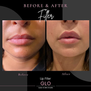 How To Find The Best Providers Of Lip Fillers In Vaughan?