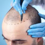 Hair Transplant In Islamabad