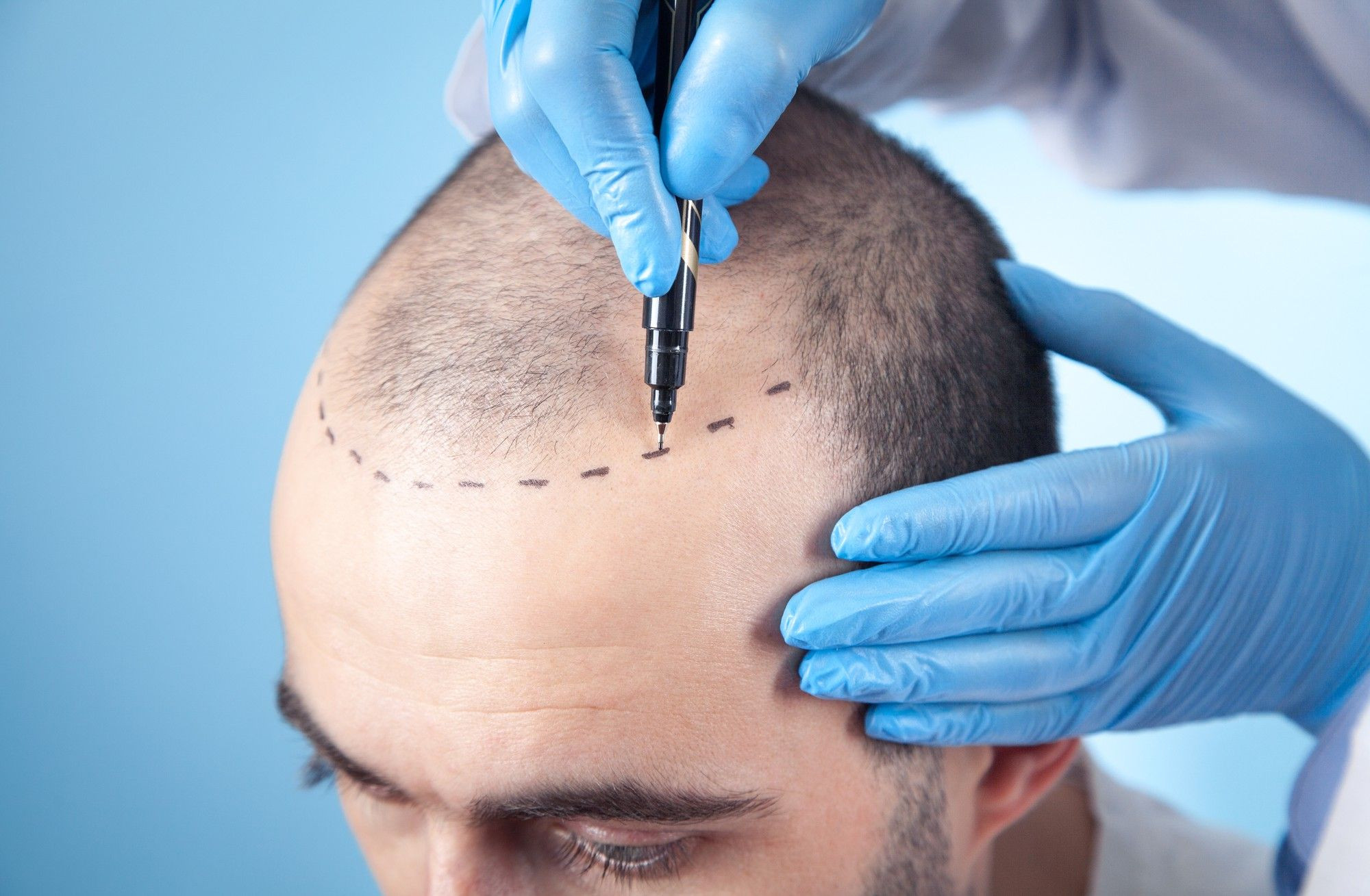 Hair Transplant In Islamabad