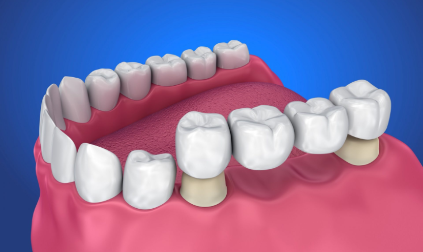 Blogs - Bang Box online - Dental Bridges for Front Teeth: What You Should Know